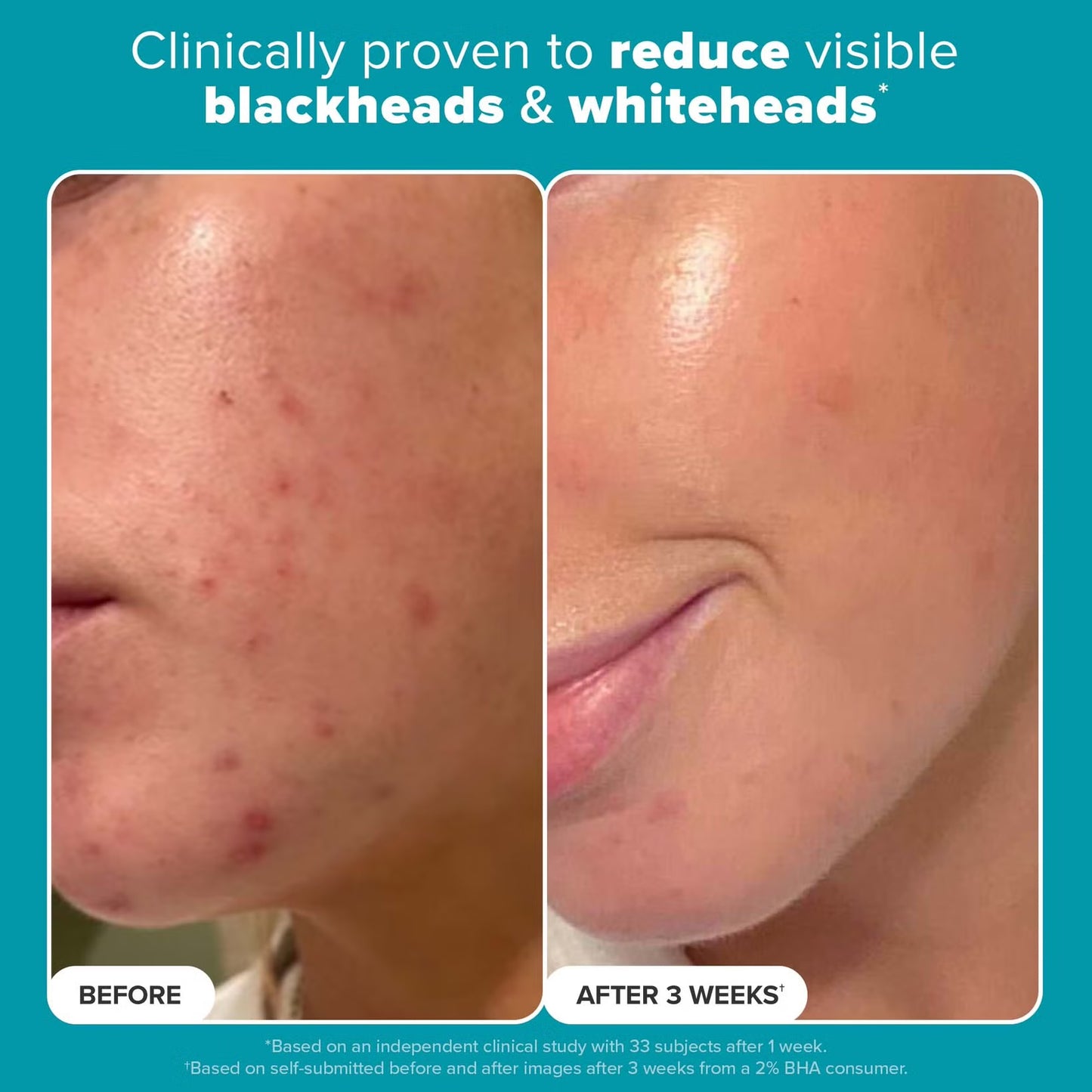 Paula's Choice Skin Perfecting 2% BHA Liquid Exfoliant (118ml)